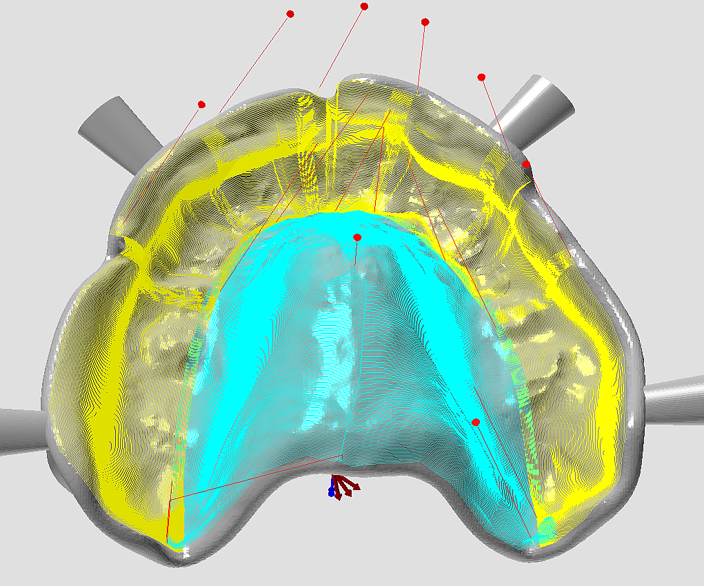 upper-jaw-alveola-ridge-milling